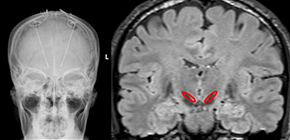 Voluntary control of brainwaves in deep brain of patients with Parkinson's disease