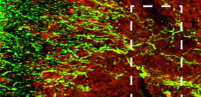 Clarification of how inflammation causes nerve damage in multiple sclerosis (MS)