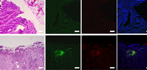 Regulatory T cells’ involvement in the progress of colorectal cancers (CRCs) found