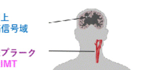 Strength in numbers: Worldwide study finds new genetic risk factors for stroke