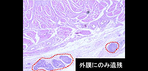 Mapping residual esophageal tumors—a glimpse into the future?