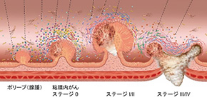 A gut feeling: microbiome changes may mean early detection of colorectal cancer