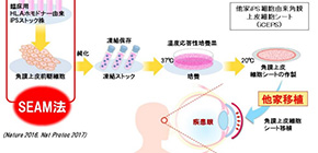 First transplantation of iPS cells-derived corneal epithelial cell sheets