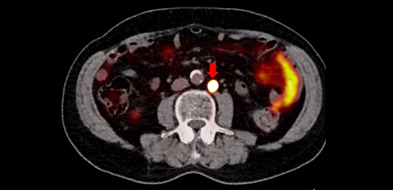 Targeting refractory prostate cancer: a novel radiopharmaceutical hits the bull’s-eye