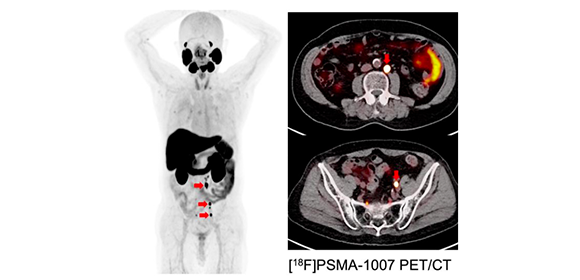 First in-human investigator-initiated clinical trial to launch for refractory prostate cancer patients: Novel alpha therapy targets prostate-specific membrane antigen