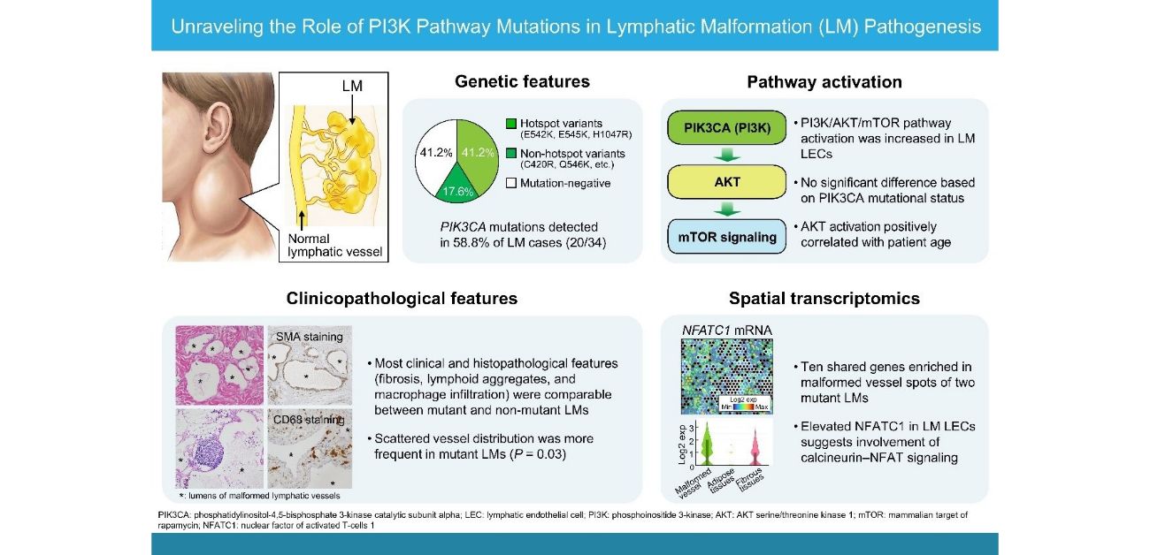 New clues to how lymphatic malformations develop