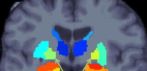 統合失調症の大脳皮質下領域の特徴を発見