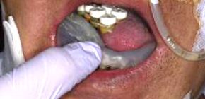 世界初！舌がん放射線治療の副作用を防止する装置を開発