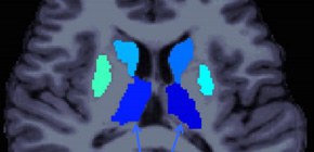 統合失調症における社会機能障害への大脳皮質下領域の関与を発見