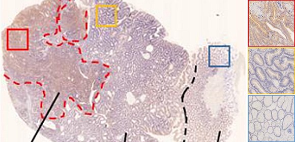 大腸がんの創薬ターゲットになり得る新規がん代謝経路の発見