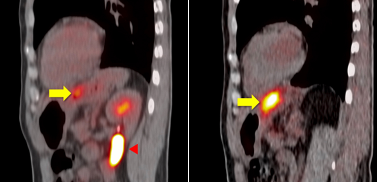 がん微小環境まで見える 高感度FAPI-PET画像検査