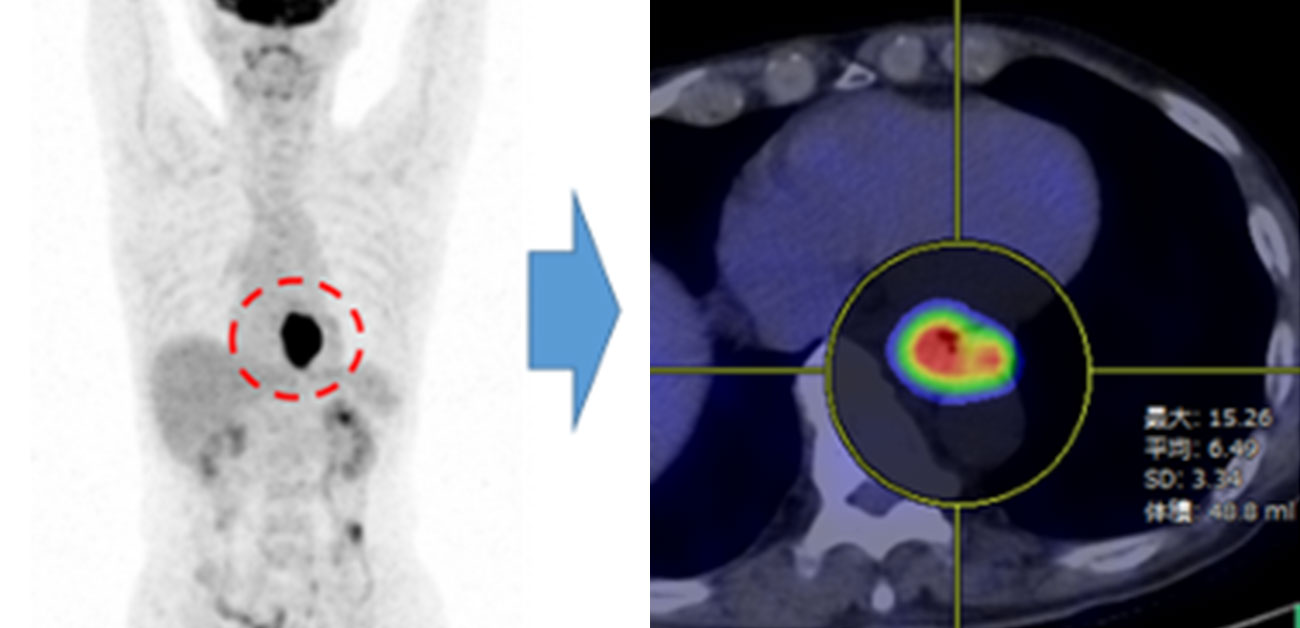 PET-CTによる新たな食道がん治療効果判定法の確立