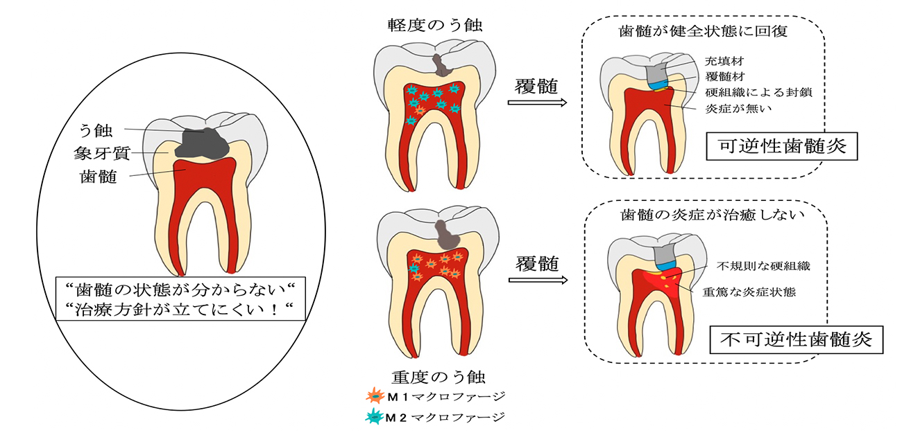 むし歯による歯痛の原因「歯髄炎」。その動物モデルを世界初作製