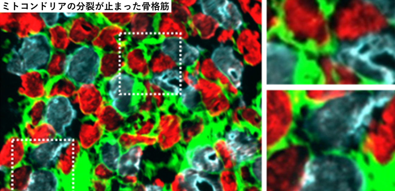 ミトコンドリア病患者の今後の見通しはどうなるのでしょうか?