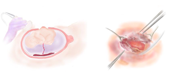 日本初、脊髄髄膜瘤の母体を介した胎児手術に成功