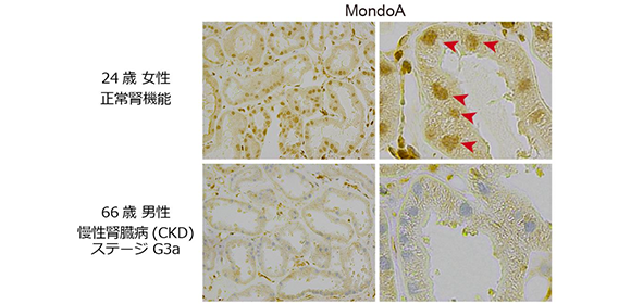 急性腎障害と慢性腎臓病の進展を阻むメカニズムを発見