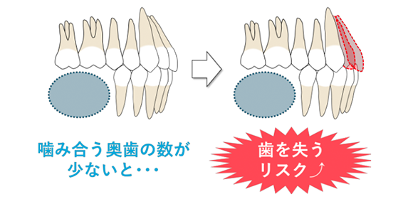 奥歯の噛み合わせ悪化で歯の喪失リスクは６倍に