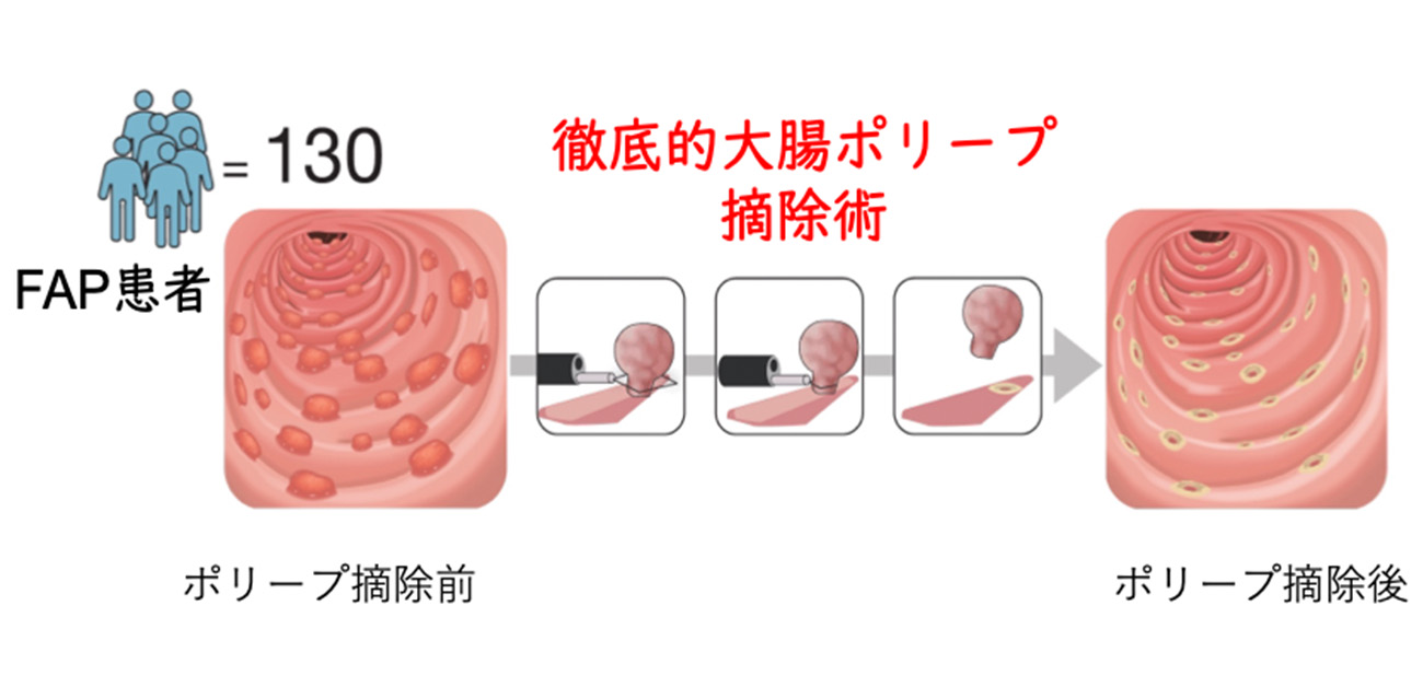 ポリープの大腸がん化に腸内細菌が関係していた