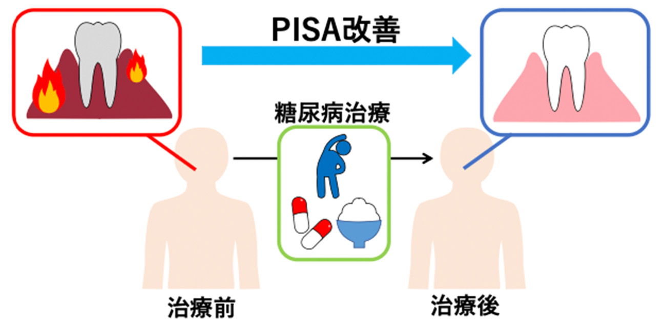 糖尿病集中治療により歯周病が改善！