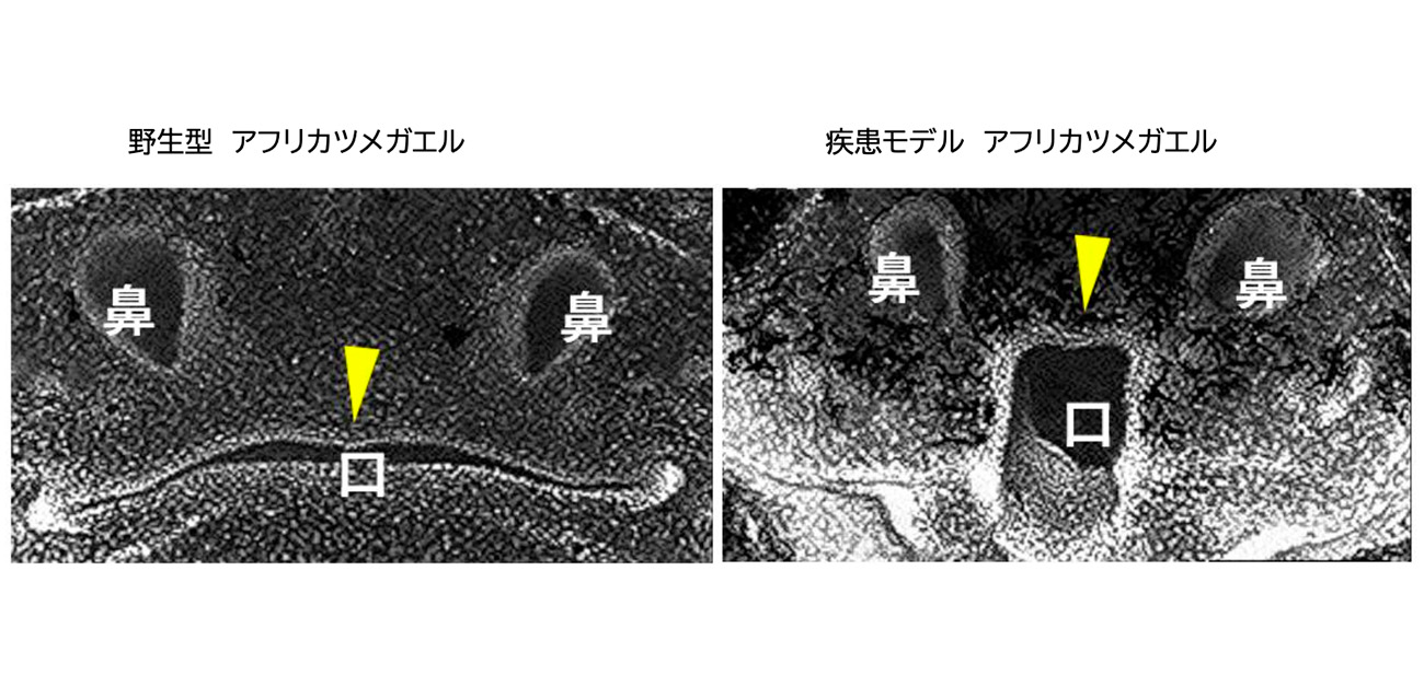 希少疾患「BWCFF症候群」による口唇口蓋裂に アクチン分子の異常動態が関与することを解明