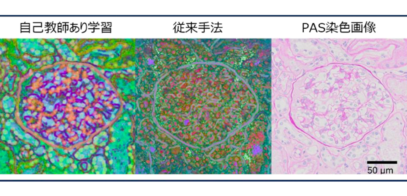 少ないデータから高精度に腎疾患を解析するAIを開発