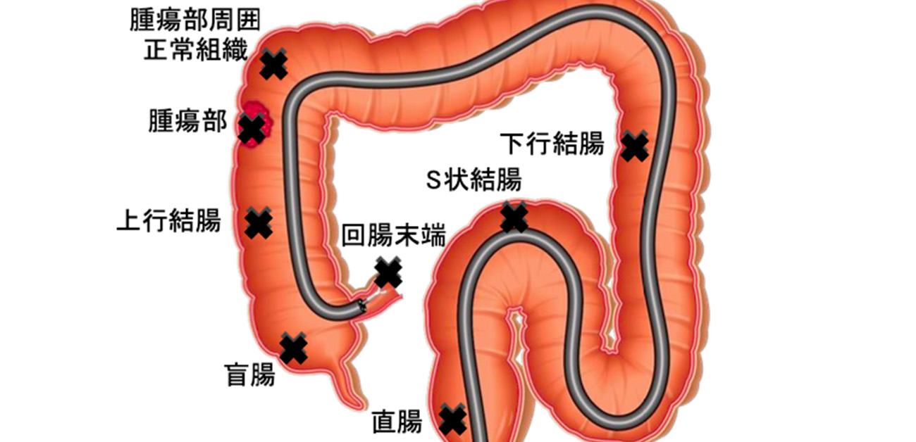 大腸は右側と左側で似て異なる臓器