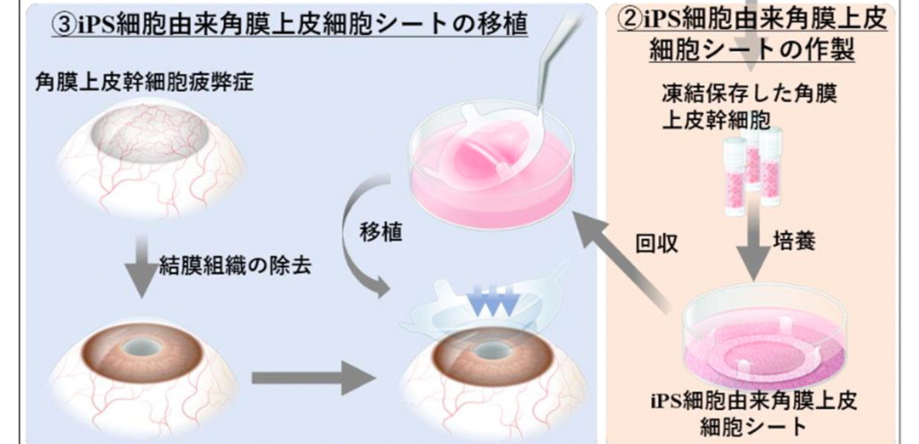 iPS細胞から作製した角膜上皮細胞シートを移植する 世界初の臨床研究を完了