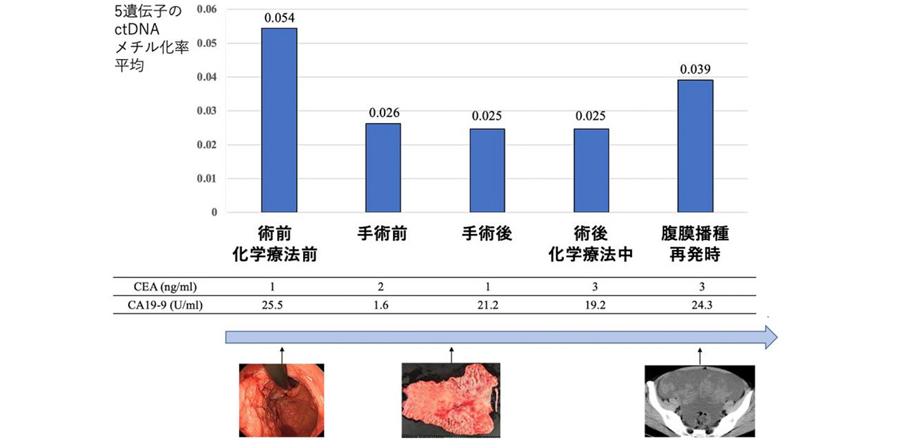 胃がんの新しい腫瘍マーカーを発見