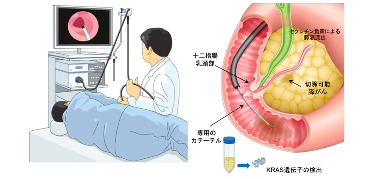 胃カメラしながら 膵がんの早期発見