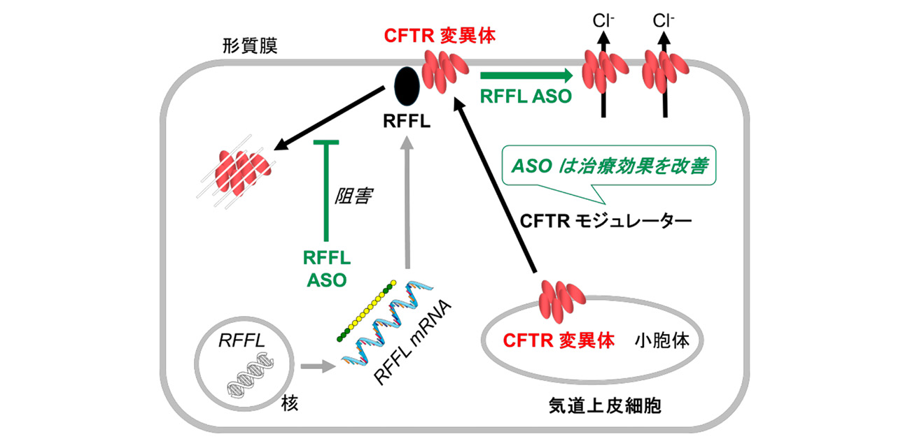遺伝性難病　嚢胞性線維症の治療に新たな可能性
