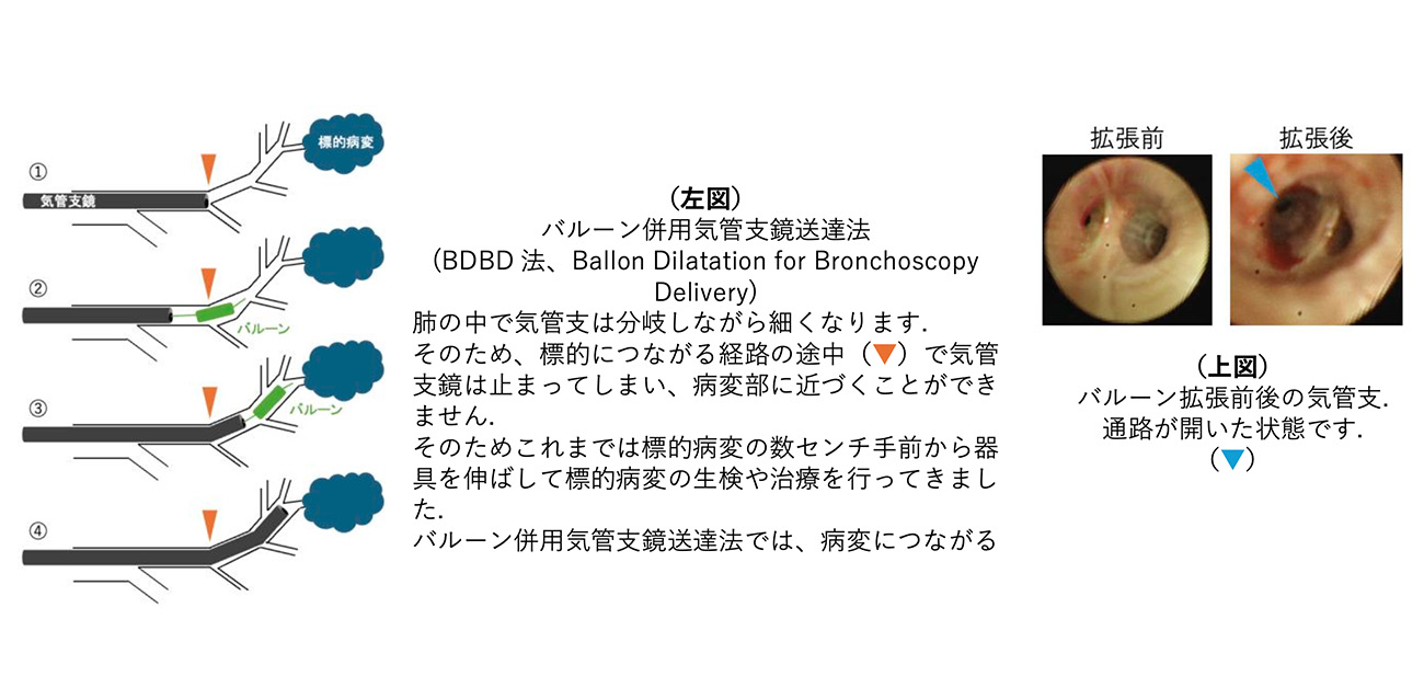 \届かなかった“肺の深部”まで新ルートを開拓!/ ふくらませて進む気管支鏡で肺癌を早期診断