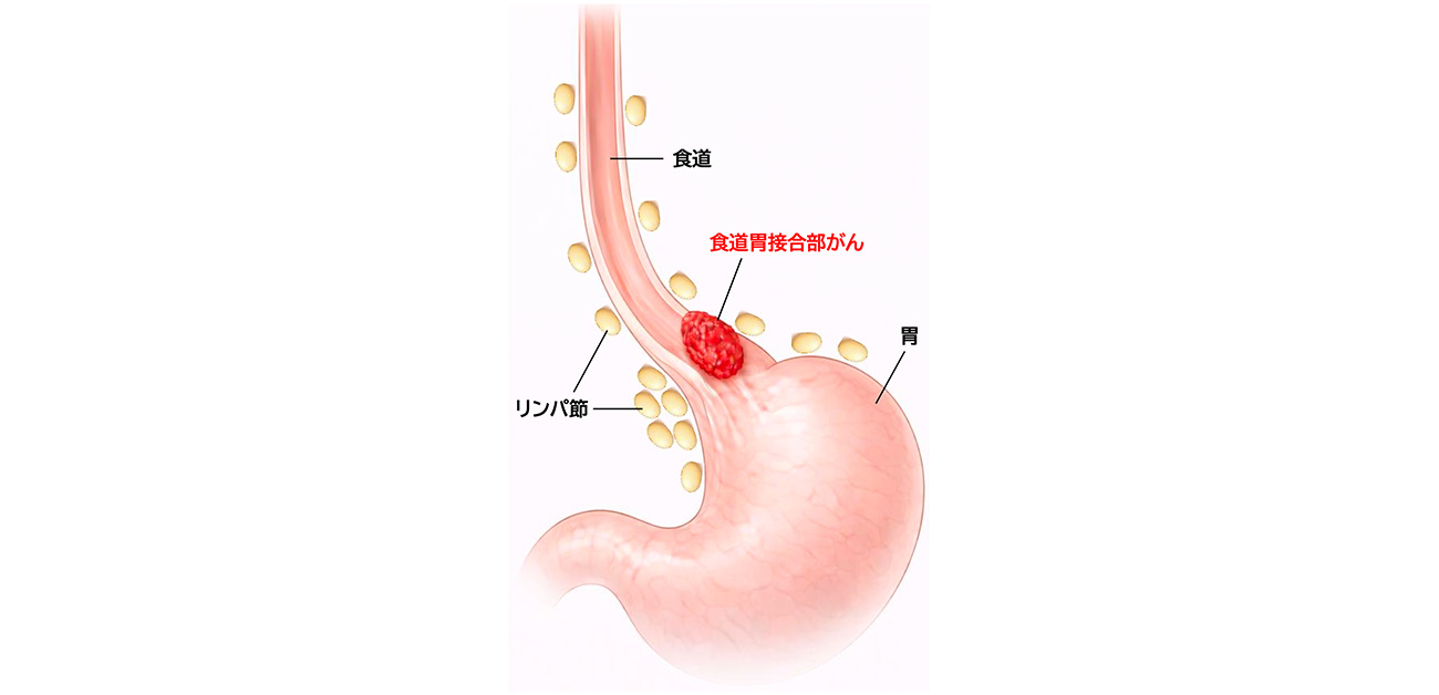 急増する食道胃接合部がん、標準手術を確立