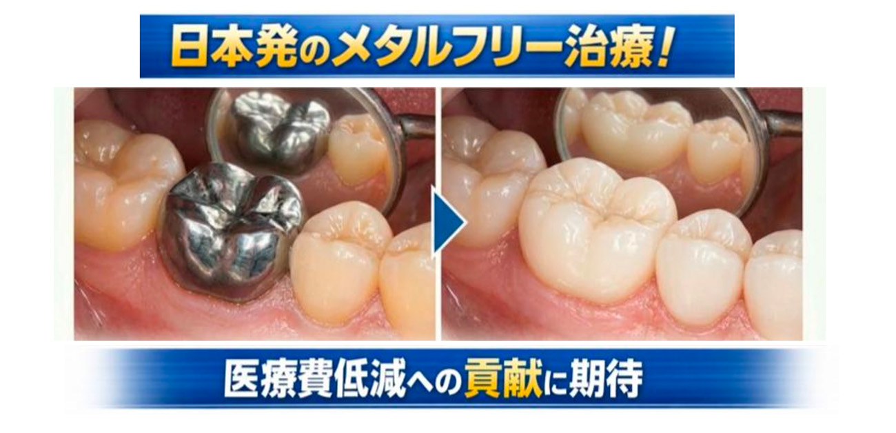 ＼かぶせの臨床経過と三次元デジタルデータを調査／ 国民健康保険の白いかぶせ（奥歯）が外れる要因究明