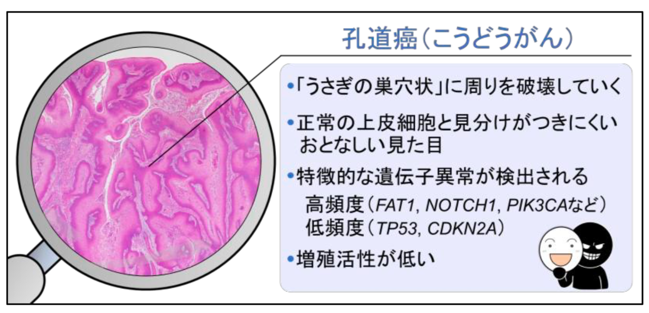＼羊の皮を被った狼を暴く／ くちのがん「孔道癌」の遺伝子異常を解明