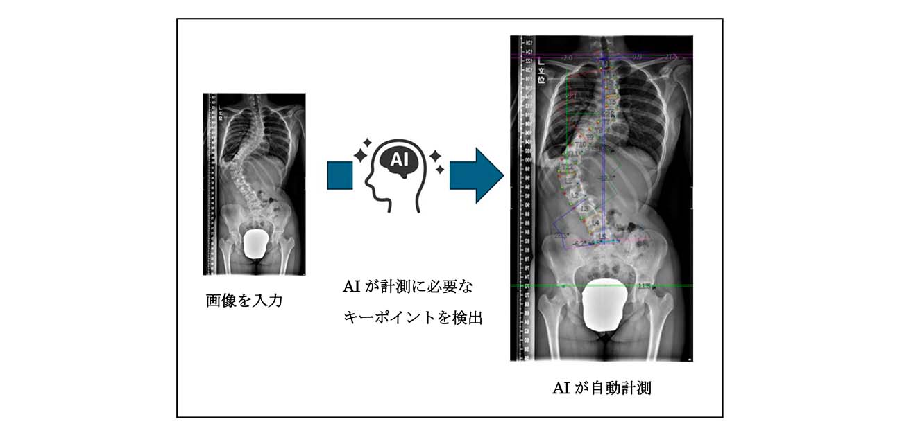 AIが側わん症のレントゲンを0.1秒で計測
