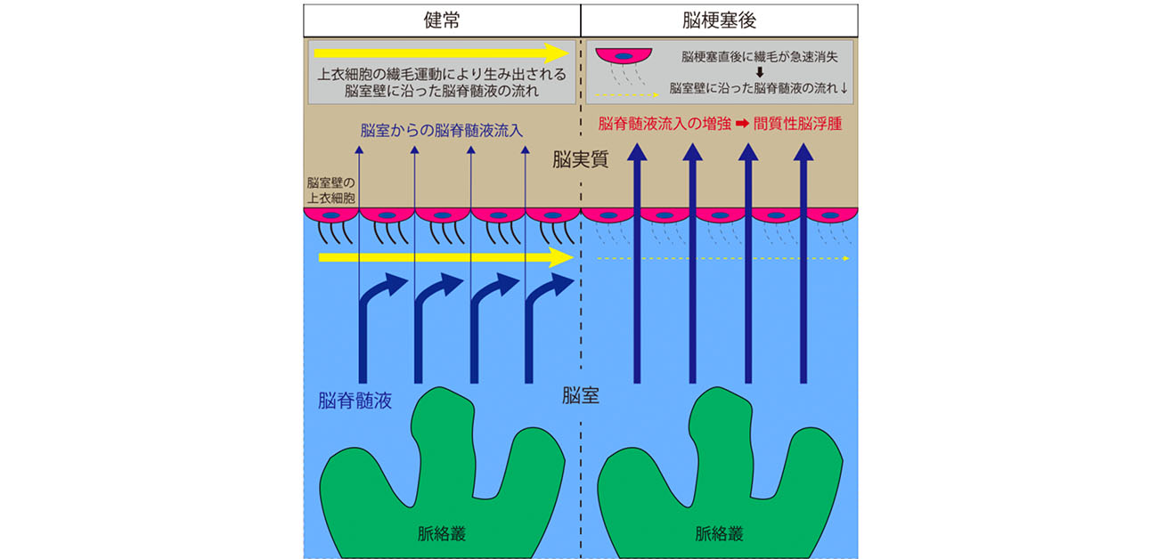 脳梗塞後の脳浮腫を悪化させる新たな仕組みを発見