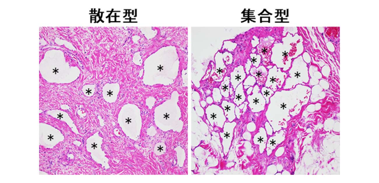 遺伝子異常に基づくリンパ管奇形の病態を解明