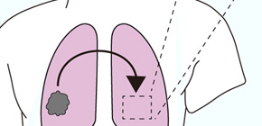 心臓ホルモンによるがん転移抑制効果についての多施設臨床研究(JANP(ジャンプ)スタディー)開始